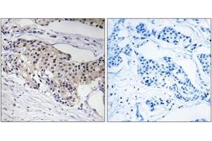 Immunohistochemistry analysis of paraffin-embedded human breast carcinoma tissue, using NDUFA3 Antibody. (NDUFA3 antibody  (AA 34-83))