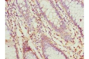 Immunohistochemistry of paraffin-embedded human colon cancer using ABIN7156187 at dilution of 1:100 (PRSS35 antibody  (AA 201-413))