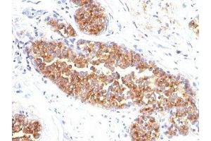 Formalin-fixed, paraffin-embedded human breast carcinoma stained with MUC1 / EMA antibody (MUC1/845). (MUC1 antibody)