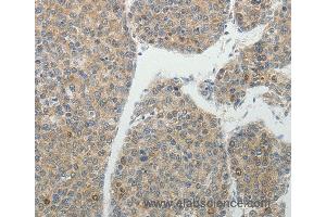 Immunohistochemistry of Human liver cancer using BIRC5 Polyclonal Antibody at dilution of 1:25