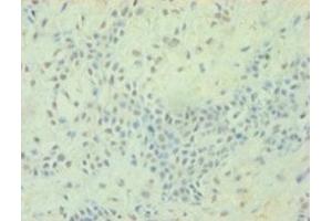 Immunohistochemistry of paraffin-embedded human breast cancer using ABIN7172823 at dilution of 1:100 (TGFB2 antibody  (AA 304-413))