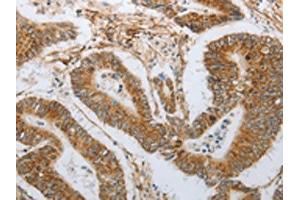 The image on the left is immunohistochemistry of paraffin-embedded Human colon cancer tissue using ABIN7191632(NEUROG1 Antibody) at dilution 1/25, on the right is treated with synthetic peptide. (Neurogenin 1 antibody)
