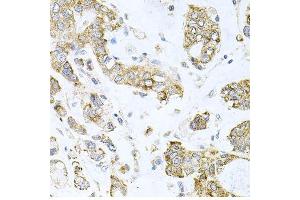 Immunohistochemistry of paraffin-embedded human gastric cancer using ALKBH8 antibody.