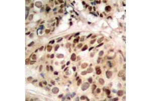 Immunohistochemical analysis of PHF1 staining in human prostate cancer formalin fixed paraffin embedded tissue section. (PHF1 antibody)