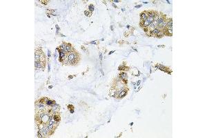 Immunohistochemistry of paraffin-embedded human gastric cancer using GALC antibody. (GALC antibody  (AA 40-300))