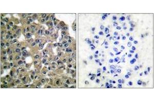 Immunohistochemistry analysis of paraffin-embedded human breast carcinoma tissue, using MAGE-1 Antibody. (MAGEA1 antibody  (AA 260-309))