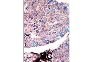 Formalin-fixed and paraffin-embedded human cancer tissue reacted with the primary antibody, which was peroxidase-conjugated to the secondary antibody, followed by AEC staining. (GSK3 alpha antibody  (N-Term))