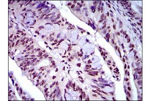 Immunohistochemical analysis of paraffin-embedded rectum cancer tissues using NAPSA mouse mAb with DAB staining. (NAPSA antibody  (AA 20-158))