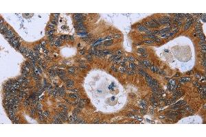 Immunohistochemistry of paraffin-embedded Human colon cancer using GH2 Polyclonal Antibody at dilution of 1:40 (Growth Hormone 2 antibody)