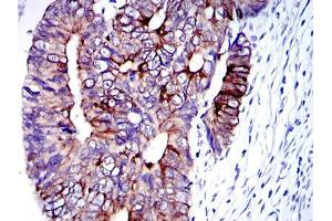 Immunohistochemical analysis of paraffin-embedded human colon cancer tissues using KRT19 mouse mAb with DAB staining. (Cytokeratin 19 antibody)