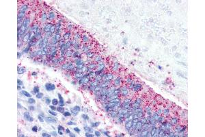 Anti-CRHR2 / CRF2 Receptor antibody IHC of human Colon, Carcinoma. (CRHR2 antibody  (N-Term))