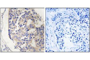 Immunohistochemistry analysis of paraffin-embedded human breast carcinoma tissue, using C1S antibody. (C1S antibody)