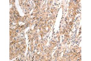 Immunohistochemical analysis of paraffin-embedded Human liver cancer tissue using at dilution 1/30. (CDH23 antibody  (C-Term))