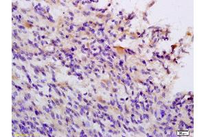 Formalin-fixed and paraffin embedded human brain glioblastoma labeled with Anti TIEG1/KLF10 Polyclonal Antibody, Unconjugated (ABIN735173) at 1:200 followed by conjugation to the secondary antibody and DAB staining (KLF10/TIEG1 antibody  (AA 423-480))