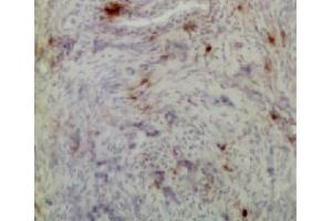 Frozen chicken ovarian tumor section was stained with Mouse Anti-Chicken CD8α-UNLB (CD8 alpha antibody)
