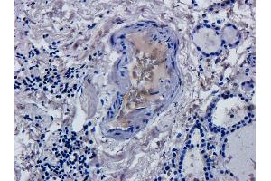 Immunohistochemical staining of human thyroid cancer using anti-CD52 antibody  Formalin fixed human thyroid cancer slices were were stained with a  at 5 µg/ml.