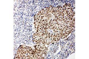 Anti-p63 antibody, IHC(P) IHC(P): Human Lung Cancer Tissue (p63 antibody  (C-Term))