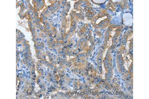 Immunohistochemistry of Human lung cancer using MUC15 Polyclonal Antibody at dilution of 1:50