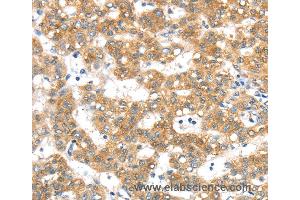 Immunohistochemistry of Human lung cancer using PTPN4 Polyclonal Antibody at dilution of 1:40 (PTPN4 antibody)