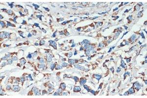 Immunohistochemistry of paraffin-embedded Human breast cancer using APC Polyclonal Antibody at dilution of 1:200 (40x lens). (APC antibody)