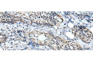 Immunohistochemistry of paraffin-embedded Human cervical cancer tissue using WDFY2 Polyclonal Antibody at dilution of 1:40(x200) (WDFY2 antibody)