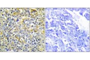 Immunohistochemistry analysis of paraffin-embedded human lung carcinoma tissue, using TFIP8 Antibody. (Cytokeratin 5 antibody  (AA 31-80))
