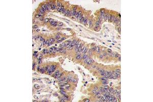 Formalin-fixed and paraffin-embedded human lung carcinoma tissue reacted with GDF5 antibody (N-term), which was peroxidase-conjugated to the secondary antibody, followed by DAB staining. (GDF5 antibody  (N-Term))