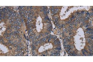 Immunohistochemistry of paraffin-embedded Human colon cancer tissue using NECTIN3 Polyclonal Antibody at dilution 1:40 (nectin-3 antibody)