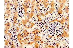 IHC image of ABIN7156517 diluted at 1:300 and staining in paraffin-embedded human liver cancer performed on a Leica BondTM system. (ITIH4 antibody  (AA 689-930))