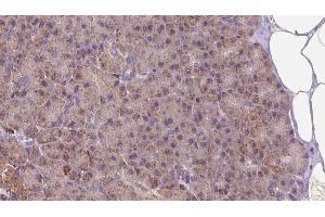 ABIN6273261 at 1/100 staining Human pancreas cancer tissue by IHC-P. (LETM1 antibody  (Internal Region))