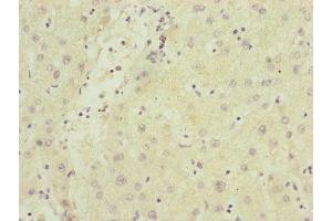 Immunohistochemistry of paraffin-embedded human liver cancer using ABIN7170343 at dilution of 1:100 (SAMM5 (AA 1-220) antibody)