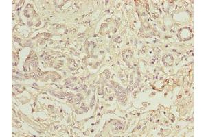 Immunohistochemistry of paraffin-embedded human pancreatic cancer using ABIN7173742 at dilution of 1:100 (TBCC antibody  (AA 2-346))