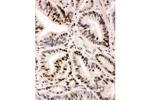 Anti-IRF1 antibody, IHC(P) IHC(P): Human Intestinal Cancer Tissue