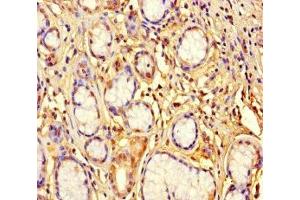 Immunohistochemistry of paraffin-embedded human gastric cancer using ABIN7176457 at dilution of 1:100