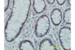 Immunoperoxidase of monoclonal antibody to PGM3 on formalin-fixed paraffin-embedded human colon tissue. (Phosphoglucomutase 3 antibody  (AA 1-542))