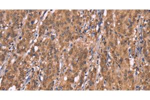 Immunohistochemistry of paraffin-embedded Human gasrtic cancer tissue using FBXO31 Polyclonal Antibody at dilution 1:40 (FBXO31 antibody)