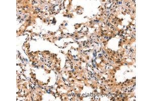 Immunohistochemistry of Human gastric cancer using CUL4B Polyclonal Antibody at dilution of 1:50