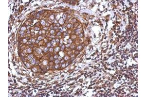 IHC-P Image Immunohistochemical analysis of paraffin-embedded human breast cancer, using TRIM25, antibody at 1:500 dilution. (TRIM25 antibody)