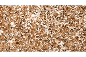 Immunohistochemistry of paraffin-embedded Human prostate cancer using RBM5 Polyclonal Antibody at dilution of 1:30 (RBM5 antibody)