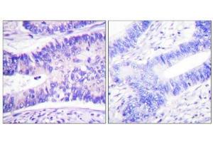 Immunohistochemistry analysis of paraffin-embedded human colon carcinoma tissue using WAVE1 (Phospho-Tyr125) antibody. (WASF1 antibody  (pTyr125))