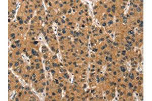 The image on the left is immunohistochemistry of paraffin-embedded Human liver cancer tissue using ABIN7190457(DEFA1/3 Antibody) at dilution 1/30, on the right is treated with synthetic peptide. (DEFA1/DEFA3 antibody)