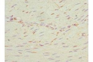 Immunohistochemistry of paraffin-embedded human colon cancer using ABIN7169101 at dilution of 1:100 (NEK3 antibody  (AA 267-506))