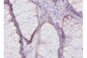 Immunohistochemistry of paraffin-embedded human colon cancer using ABIN7145472 at dilution of 1:50 (beta Defensin 1 antibody  (AA 33-68))