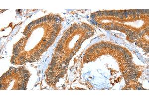Immunohistochemistry of paraffin-embedded Human colon cancer using ACOT11 Polyclonal Antibody at dilution of 1:40 (ACOT11 antibody)