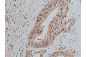 ABIN6267373 at 1/50 staining human colon carcinoma tissue sections by IHC-P. (Src antibody  (pTyr530))