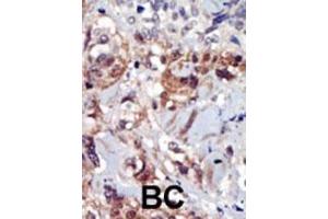 Formalin-fixed and paraffin-embedded human cancer tissue reacted with the primary antibody, which was peroxidase-conjugated to the secondary antibody, followed by AEC staining. (PIP4K2A antibody  (C-Term))