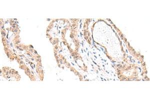 Immunohistochemistry of paraffin-embedded Human thyroid cancer tissue using FANCE Polyclonal Antibody at dilution of 1:50(x200) (FANCE antibody)
