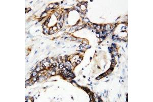 Anti-uPA Receptor antibody, IHC(P) IHC(P): Human Mammary Cancer Tissue (PLAUR antibody  (C-Term))
