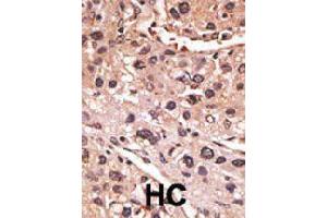 Formalin-fixed and paraffin-embedded human hepatocellular carcinoma tissue reacted with MAGEA12 polyclonal antibody  , which was peroxidase-conjugated to the secondary antibody, followed by AEC staining. (MAGEA12 antibody  (N-Term))