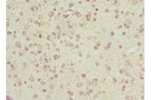 Immunohistochemistry of paraffin-embedded human glioma using ABIN7143513 at dilution of 1:100 (ARL6 antibody  (AA 1-186))